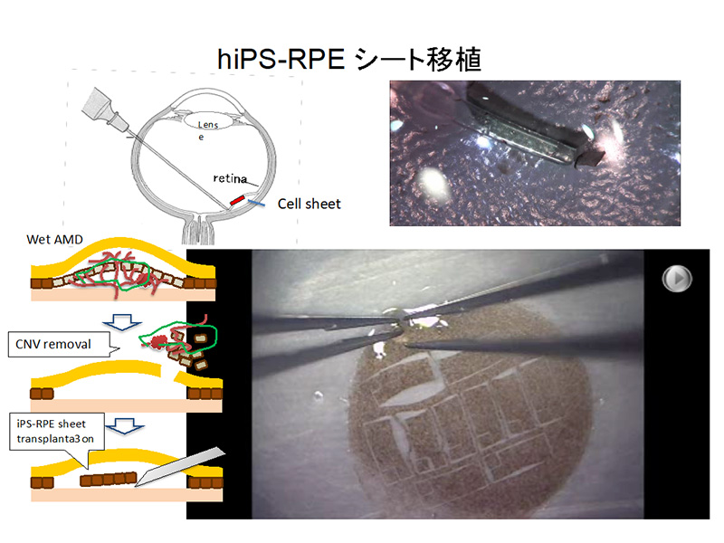 図1 hiPS-RPE シート移植