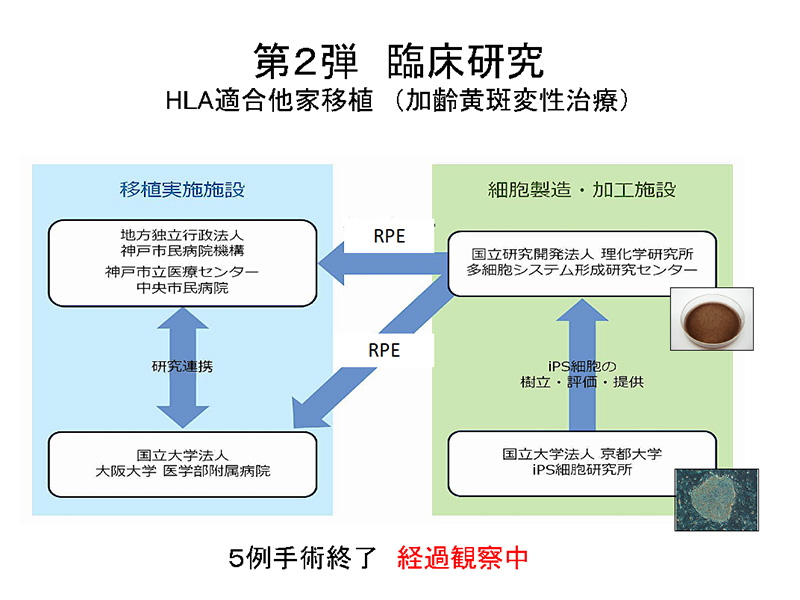 図2 第2段臨床研究 HLA適合他家移植（加齢黄斑変性治療）