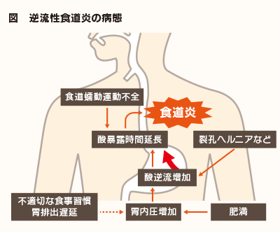 図 逆流性食道炎の病態