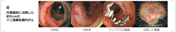 図　内視鏡的に切除した約６cmの十二指腸粘膜内がん