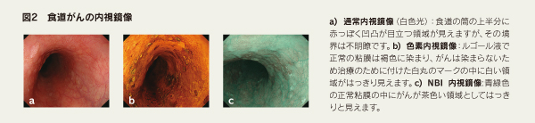 図2　食道がんの内視鏡像