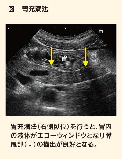 図　胃充満法