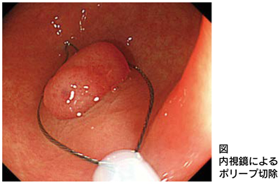 図　内視鏡によるポリープ切除