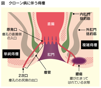 図　クローン病に伴う痔瘻